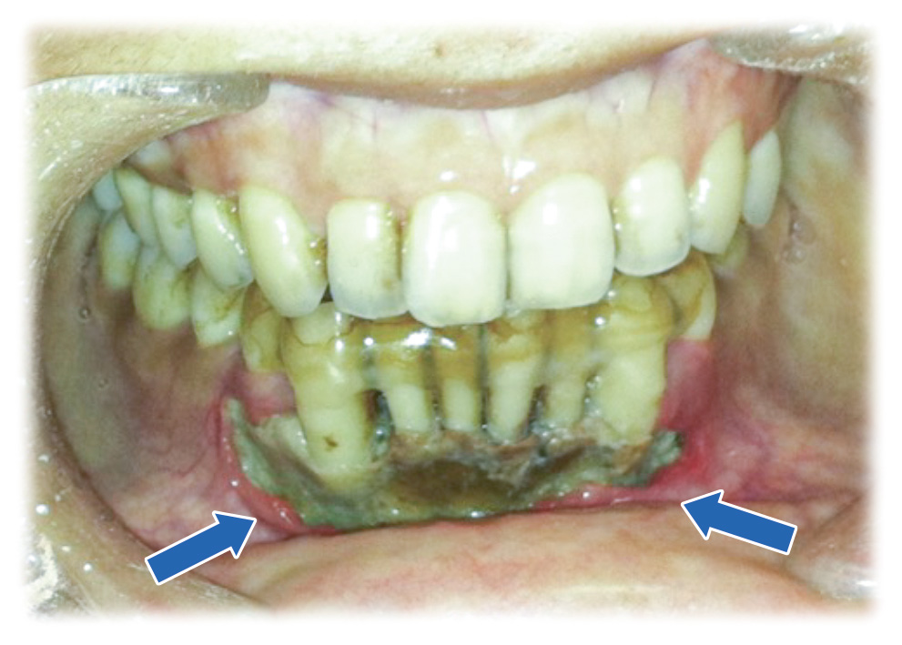 壊死した下顎骨が歯茎から露出